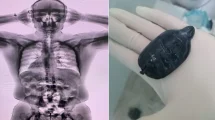 Detectan un pasajero con 48 capsulas de cocaina ingeridas en el aeropuerto de la 20260504 221149 S6Wu