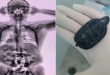 Detectan un pasajero con 48 capsulas de cocaina ingeridas en el aeropuerto de la 20260504 221149 S6Wu